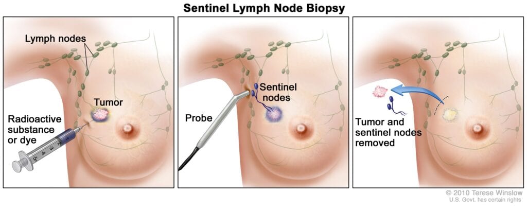 gamma probe identification of sentinel lymph node