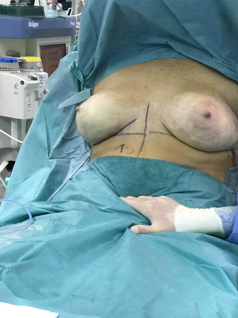 nipple sparing mastectomy