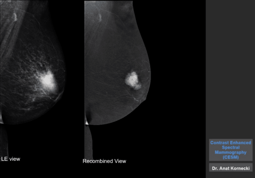 Pre-contrast (A, B, C, D) and post-contrast recombined images (E, F, G