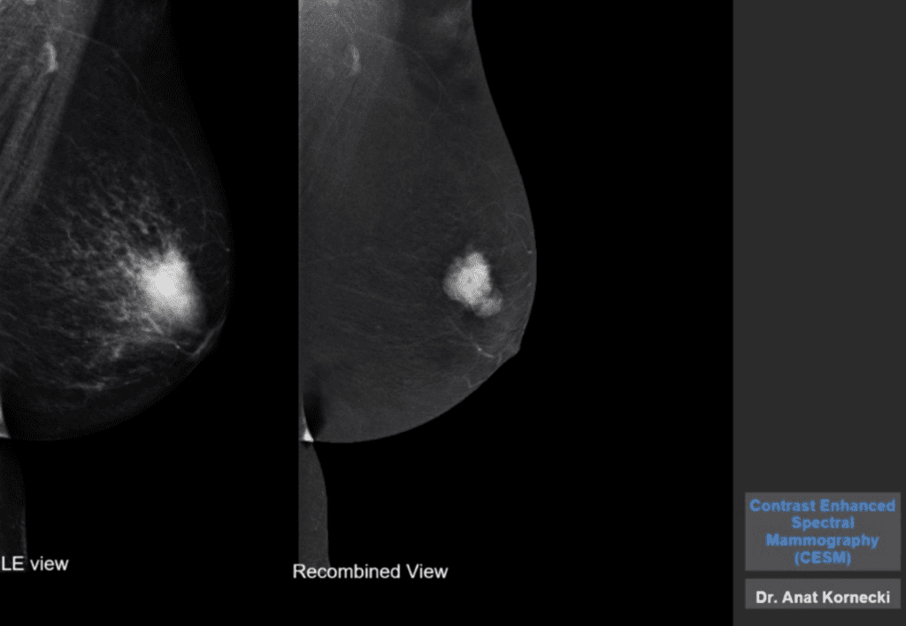 triple-negative-breast-cancer-2020-year-in-review