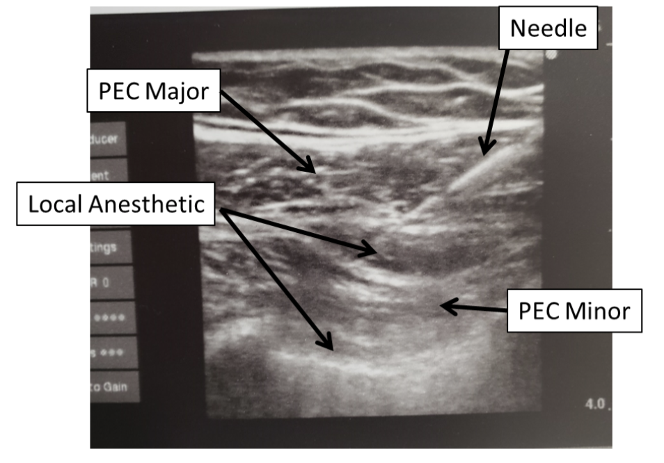 Ultrasound image showing injected local anesthesia placement
